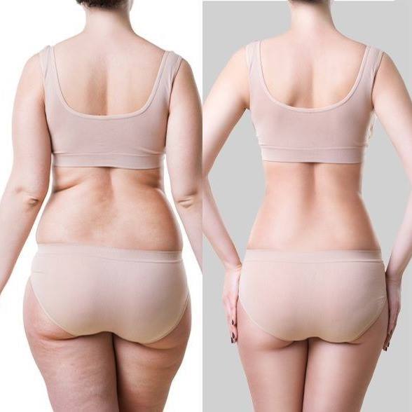 Lipo sem Corte — imagem do catálogo original Universo da Mulher