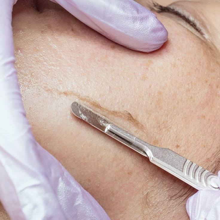 Dermaplaning — imagem do catálogo original Universo da Mulher